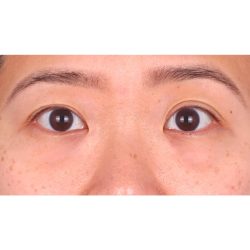 Lower Blepharoplasty Before & After Patient #524