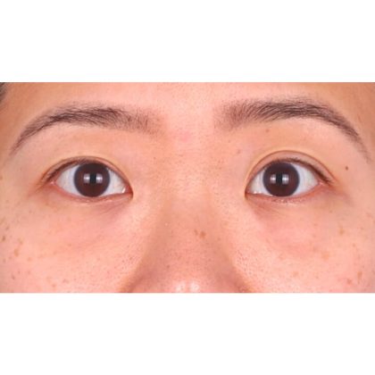 Lower Blepharoplasty Before & After Patient #524