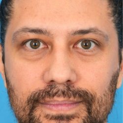 Lower Blepharoplasty Before & After Patient #527