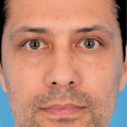 Lower Blepharoplasty Before & After Patient #527