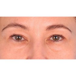 Quad Blepharoplasty Before & After Patient #399