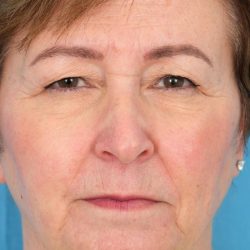 CO2 Laser Resurfacing Before & After Patient #401