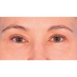 Quad Blepharoplasty Before & After Patient #399