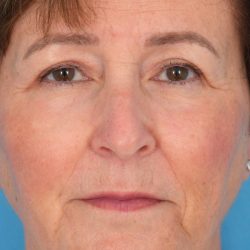 CO2 Laser Resurfacing Before & After Patient #401