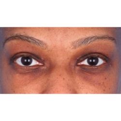 Upper Blepharoplasty Before & After Patient #693