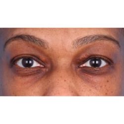 Upper Blepharoplasty Before & After Patient #693