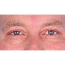 Upper Blepharoplasty Before & After Patient #697