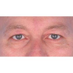 Upper Blepharoplasty Before & After Patient #697