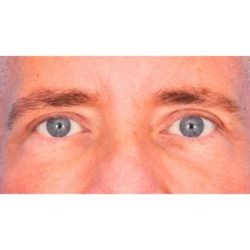Upper Blepharoplasty Before & After Patient #699