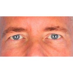 Upper Blepharoplasty Before & After Patient #699