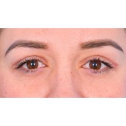 Upper Blepharoplasty Before & After Patient #700
