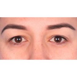 Upper Blepharoplasty Before & After Patient #700