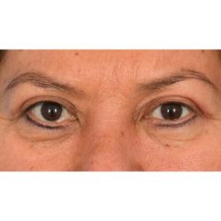 Upper Blepharoplasty Before & After Patient #701