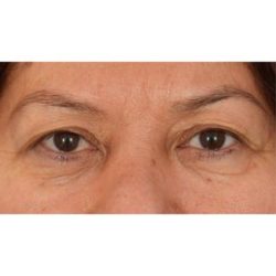 Upper Blepharoplasty Before & After Patient #701