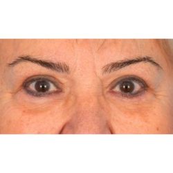 Upper Blepharoplasty Before & After Patient #702