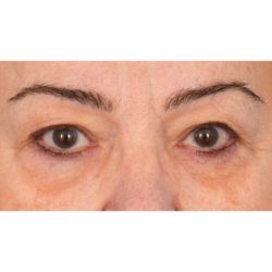 Upper Blepharoplasty Before & After Patient #702
