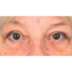 Upper Blepharoplasty Before & After Patient #728