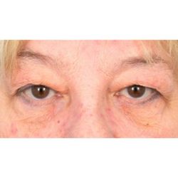 Upper Blepharoplasty Before & After Patient #728