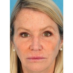 Upper Blepharoplasty Before & After Patient #1309