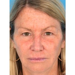 Upper Blepharoplasty Before & After Patient #1309