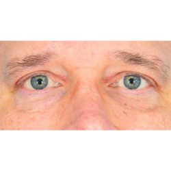 Upper Blepharoplasty Before & After Patient #1308