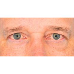 Upper Blepharoplasty Before & After Patient #1308