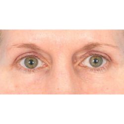 Upper Blepharoplasty Before & After Patient #1318