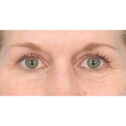 Upper Blepharoplasty Before & After Patient #1318