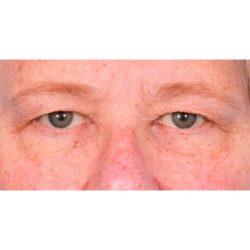 Upper Blepharoplasty Before & After Patient #1315