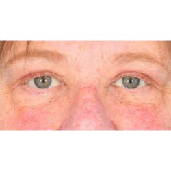 Upper Blepharoplasty Before & After Patient #1315