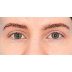 Upper Blepharoplasty Before & After Patient #1310