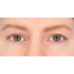 Upper Blepharoplasty Before & After Patient #1310