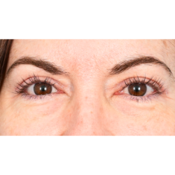 Upper Blepharoplasty Before & After Patient #1320
