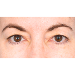 Upper Blepharoplasty Before & After Patient #1320