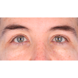 Upper Blepharoplasty with Browpexy Before & After Patient #813