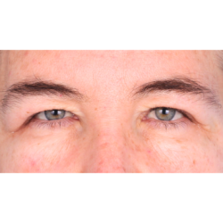 Upper Blepharoplasty with Browpexy Before & After Patient #813