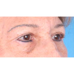 Upper Blepharoplasty Before & After Patient #814