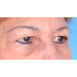 Upper Blepharoplasty Before & After Patient #814