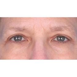 Upper Blepharoplasty Before & After Patient #694