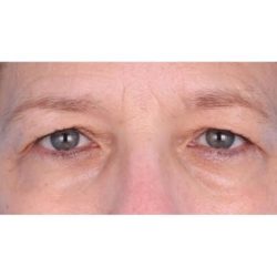 Upper Blepharoplasty Before & After Patient #694
