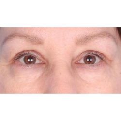 Upper Blepharoplasty Before & After Patient #695