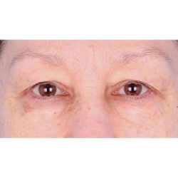 Upper Blepharoplasty Before & After Patient #695