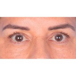 Upper Blepharoplasty Before & After Patient #696