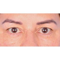 Upper Blepharoplasty Before & After Patient #696