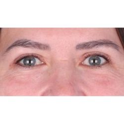 Upper Blepharoplasty Before & After Patient #698
