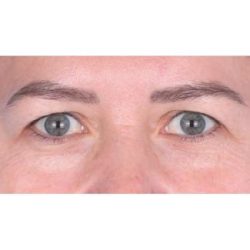 Upper Blepharoplasty Before & After Patient #698