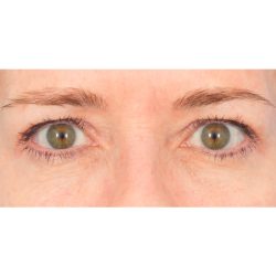Upper Blepharoplasty Before & After Patient #1313