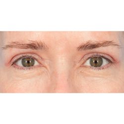 Upper Blepharoplasty Before & After Patient #1313