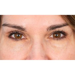 Lower Blepharoplasty Before & After Patient #1676