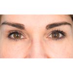 Lower Blepharoplasty Before & After Patient #1676